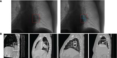 Respiratory Prediction Based on Multi-Scale Temporal Convolutional Network for Tracking Thoracic Tumor Movement